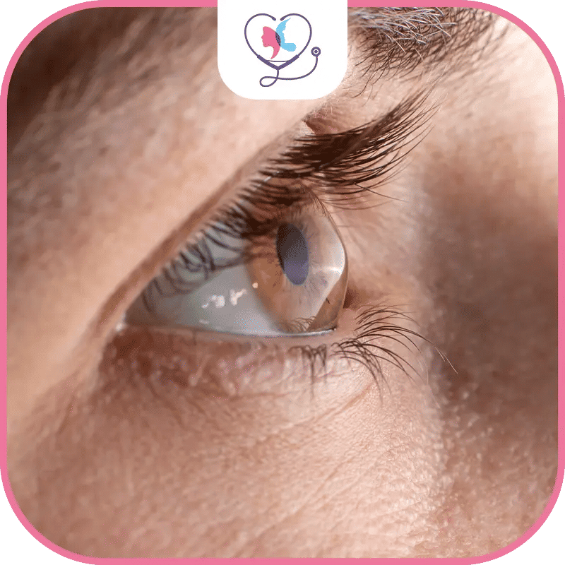 ماهو القرنية المخروطية؟