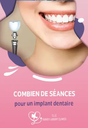 Combien de séances pour un implant dentaire