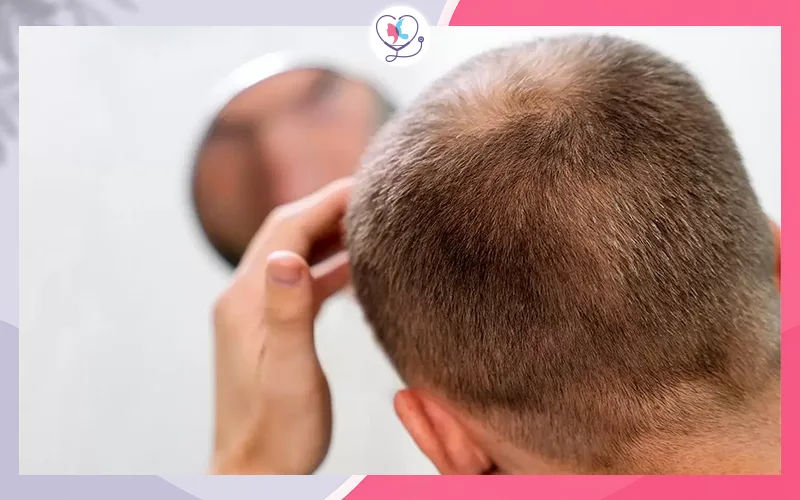 متى تكون زراعة الشعر مناسبة لعلاج تساقط الشعر الوراثي؟