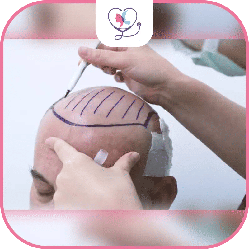 What is Hair Transplant Revision Surgery?