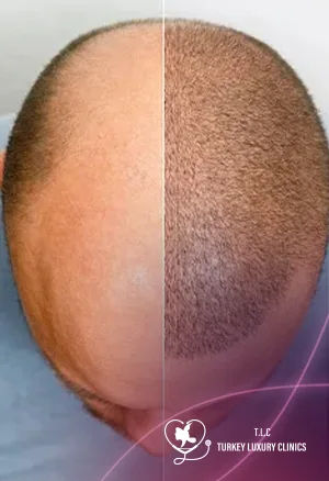 Hair Transplant Experience with Photos: Complete Patient Journey