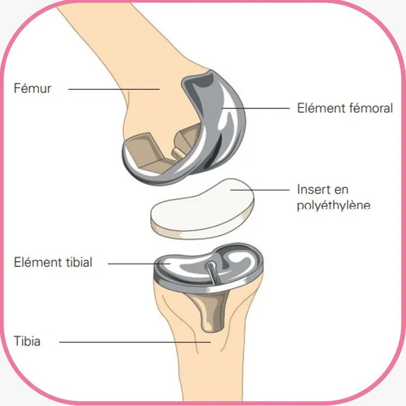 composition prothèse totale du genou
