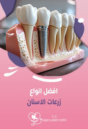 افضل انواع زرعات الاسنان: السويسرية، السويدية، الألمانية