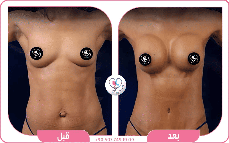 اختاري تركيا لاكشري كلينك لعملية شد الثدي