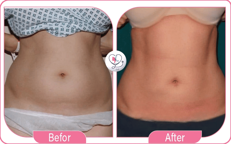 1. Front Abdomen: Lipo 360 12 Areas Target