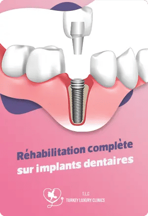 Réhabilitation complète sur implants dentaires : Solutions durables