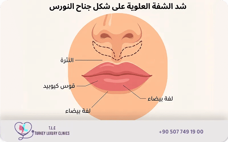  جناح النورس Direct / Gullwing Lip Lift