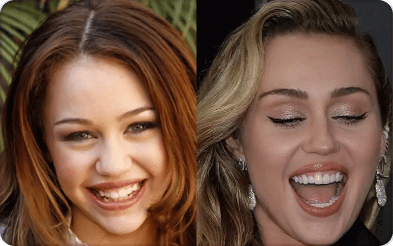Miley Cyrus showing her new teeth and modern smile in 2025 after a smile makeover, highlighting a natural and polished look.