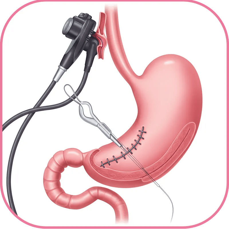 Endoscopic Sleeve Gastroplasty Turkey 2025: Cost, Steps and Photos