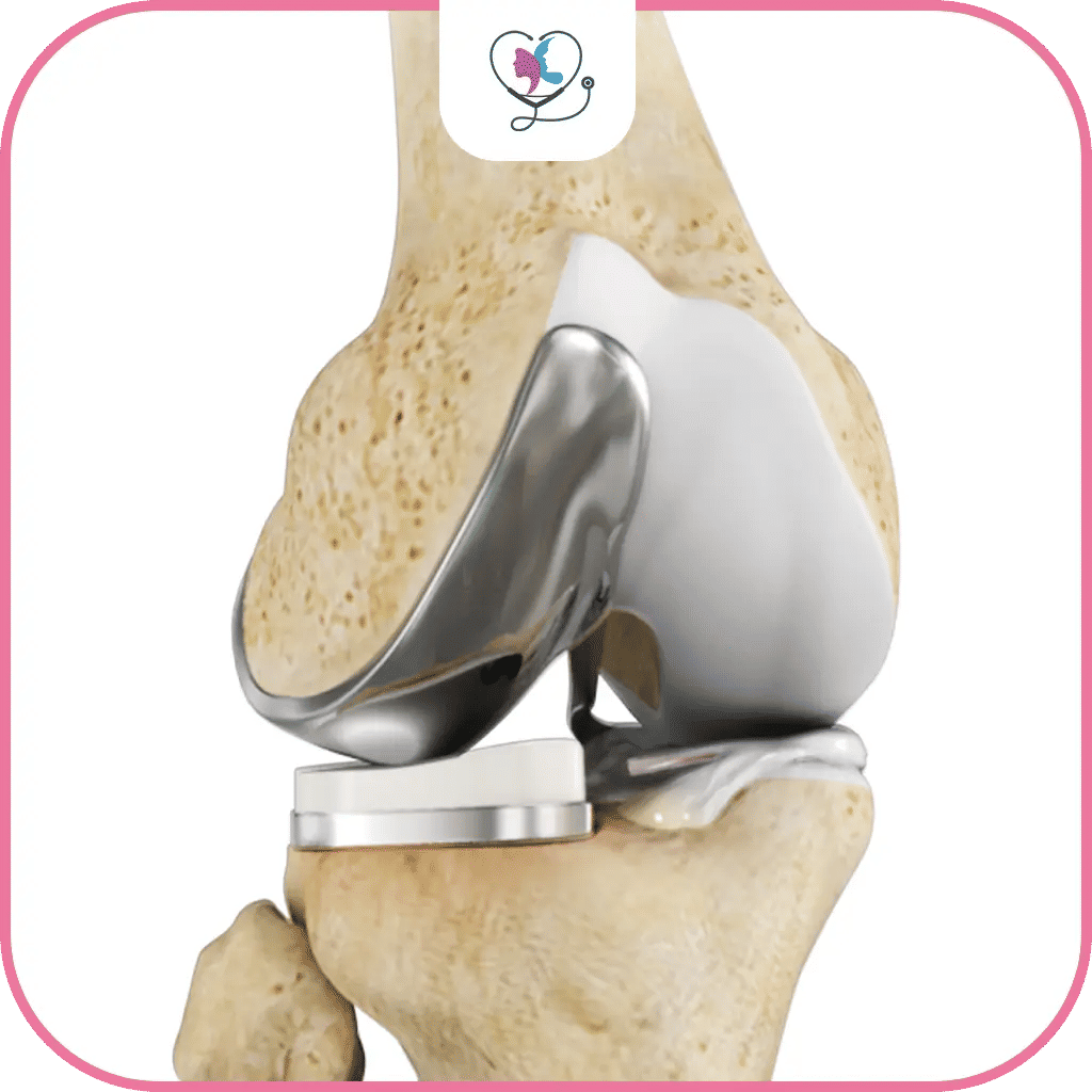 الاستبدال الجزئي للركبة في تركيا