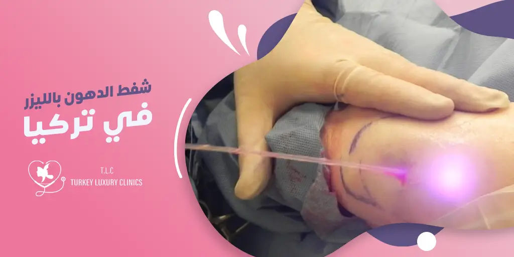 شفط الدهون بالليزر في تركيا:دليلك الشامل