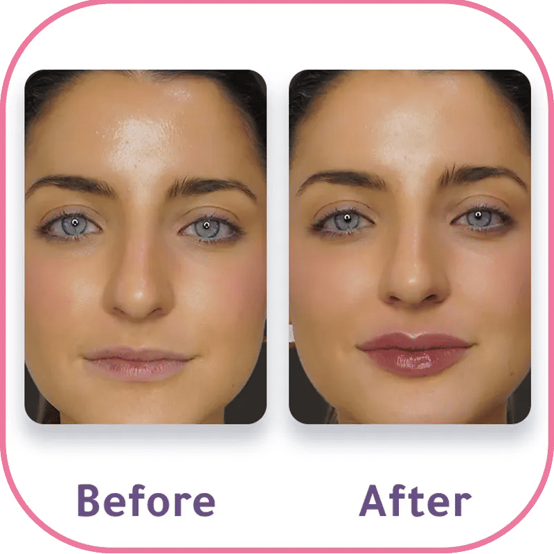 Natural looking lip filler before and after treatment in Turkey