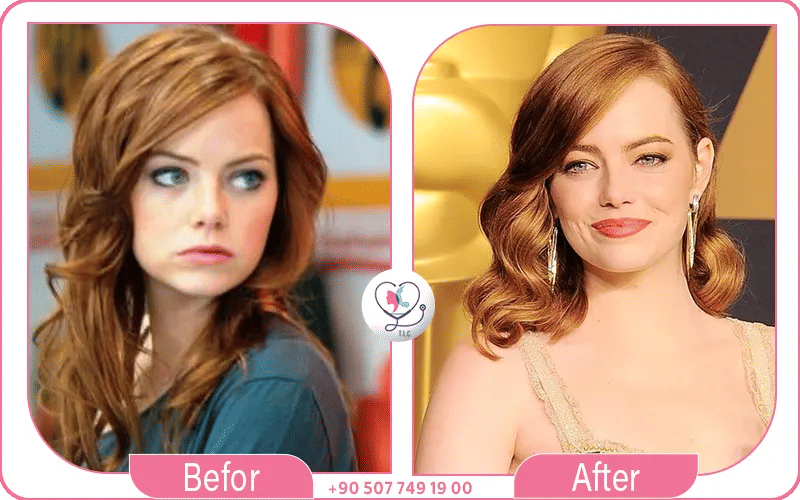 Emma Stone Before and After Plastic Surgery