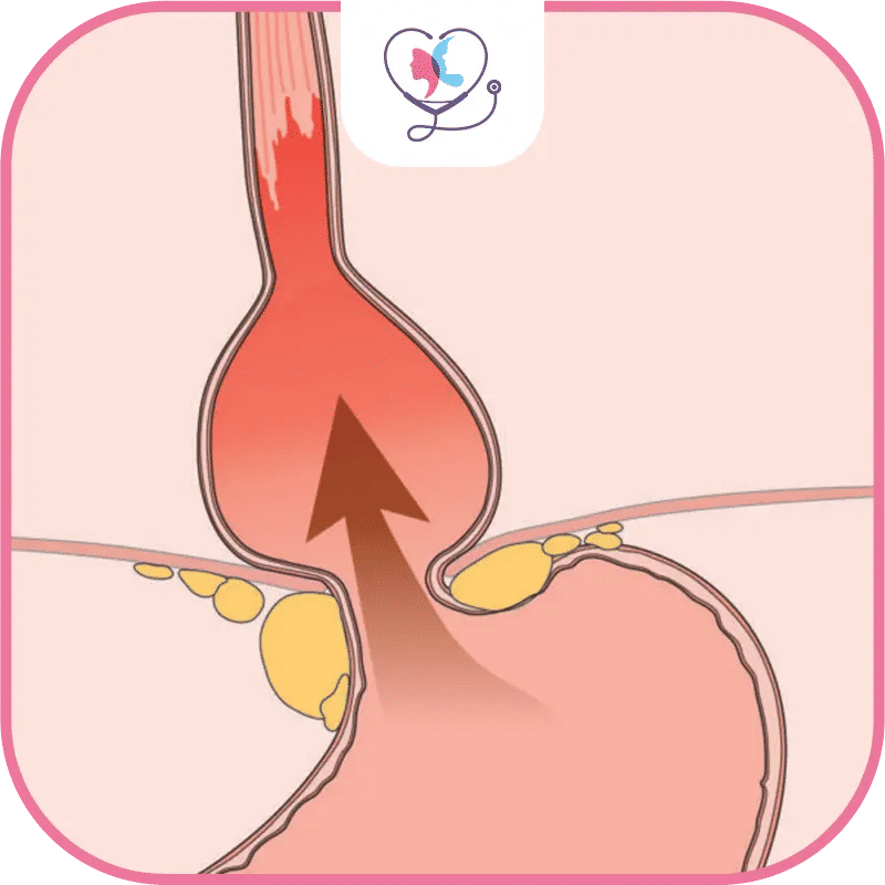 Comment la sleeve modifie-t-elle le système digestif ?