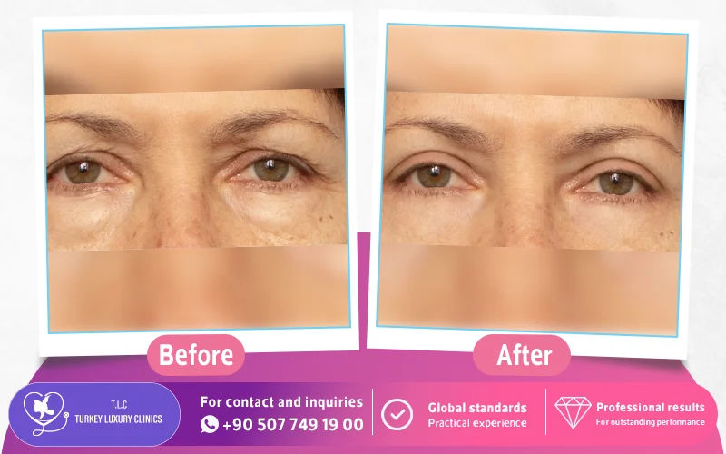 Lower Eyelid Surgery Before and After Photos