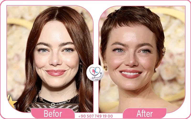 Emma Stone Plastic Surgery 2023–2025 Analysis