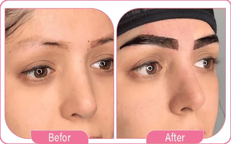 Eyebrow Hair Transplant Aftercare Tips and Recommendations