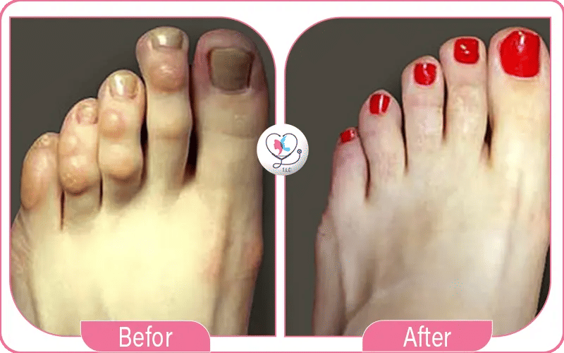صور عملية تجميل أصابع القدم قبل وبعد