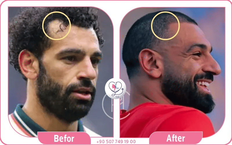 هل قام محمد صلاح بزراعة الشعر؟