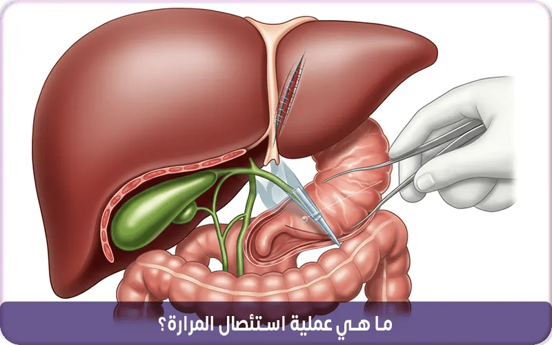 ما هي عملية استئصال المرارة؟