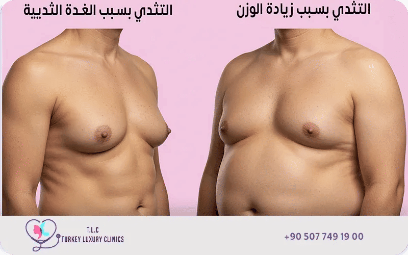 الفرق بين التثدي الحقيقي والكاذب