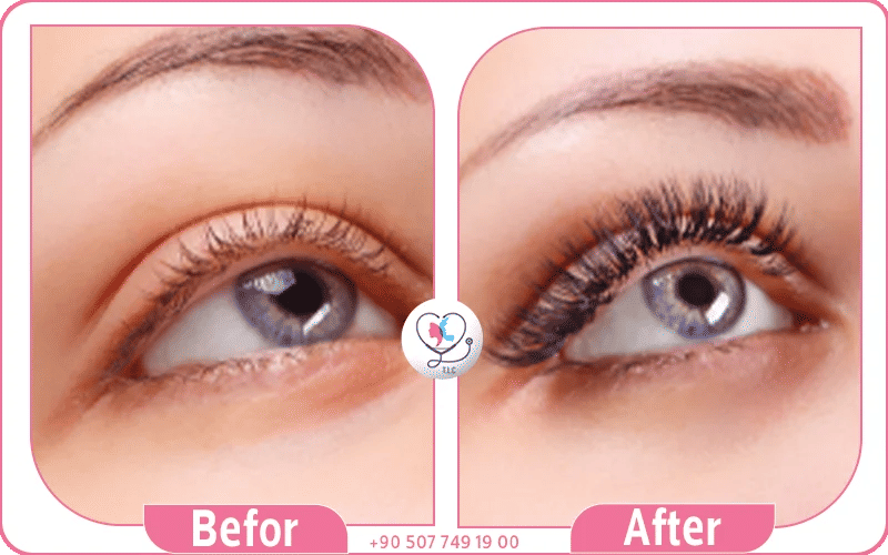 زراعة الرموش قبل وبعد زراعة الرموش قبل وبعد