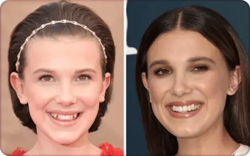 Actress Millie Bobby Brown showing a wrinkle-free forehead, sparking Botox speculation. Millie Bobby Brown Before and After