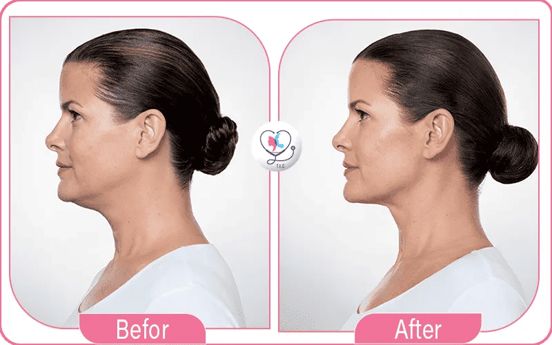 المرشحون لإجراء شفط اللغلوغ بالليزر