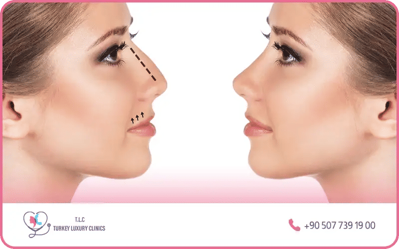 Facteurs qui influencent le tarif d’une rhinoplastie de la pointe