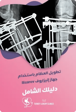 تطويل العظام باستخدام جهاز اليزاروف Ilizarovfeatured image