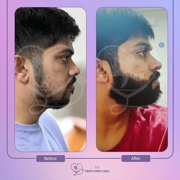 Beard Transplant Before and After in Turkey