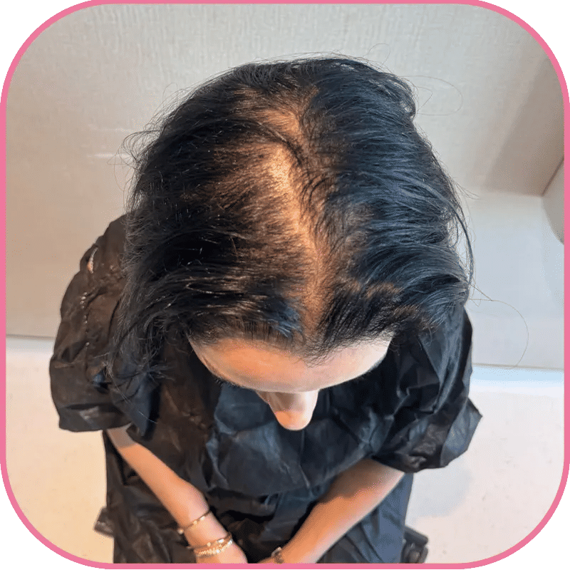 What is Hair Transplant for Thinning Hair