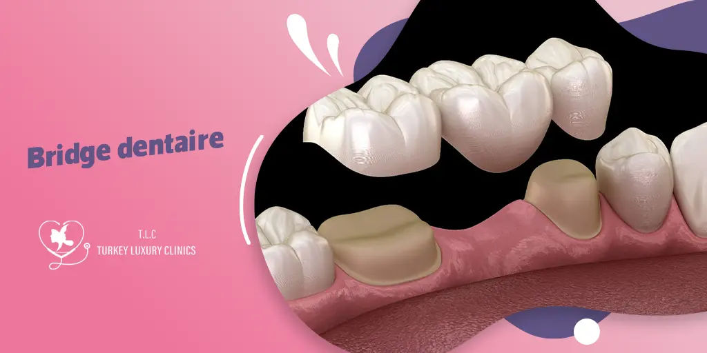 Bridge dentaire : Guide complet pour un sourir sain et éclatant