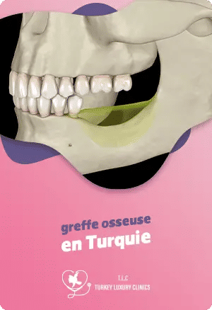 Greffe osseuse en Turquie