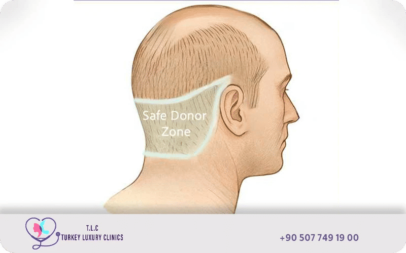 Side profile diagram showing the safe donor zone for hair transplant in the occipital region of the scalp