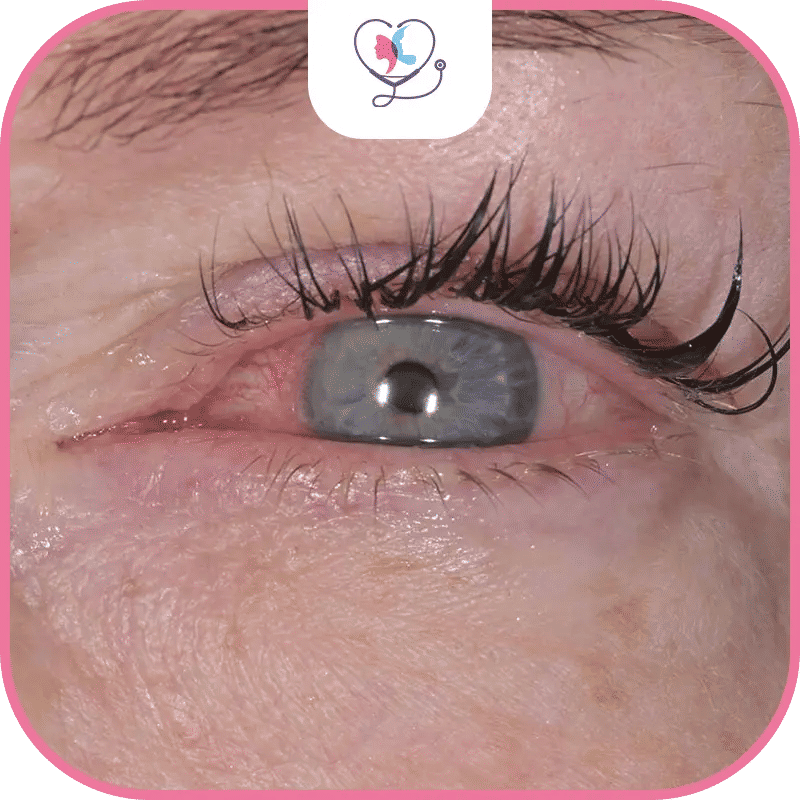 التهاب القرنية