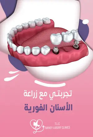 تجربتي مع زراعة الأسنان الفورية: نتائج حقيقية مع الصور