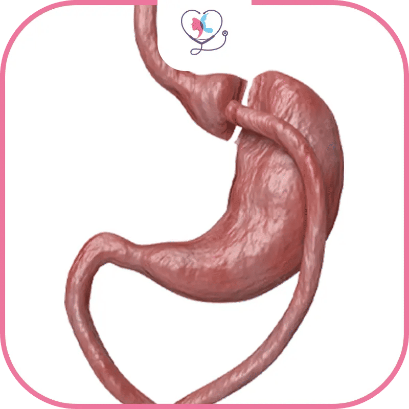 ما الفرق بين تكميم المعدة وتحويل مسار المعدة