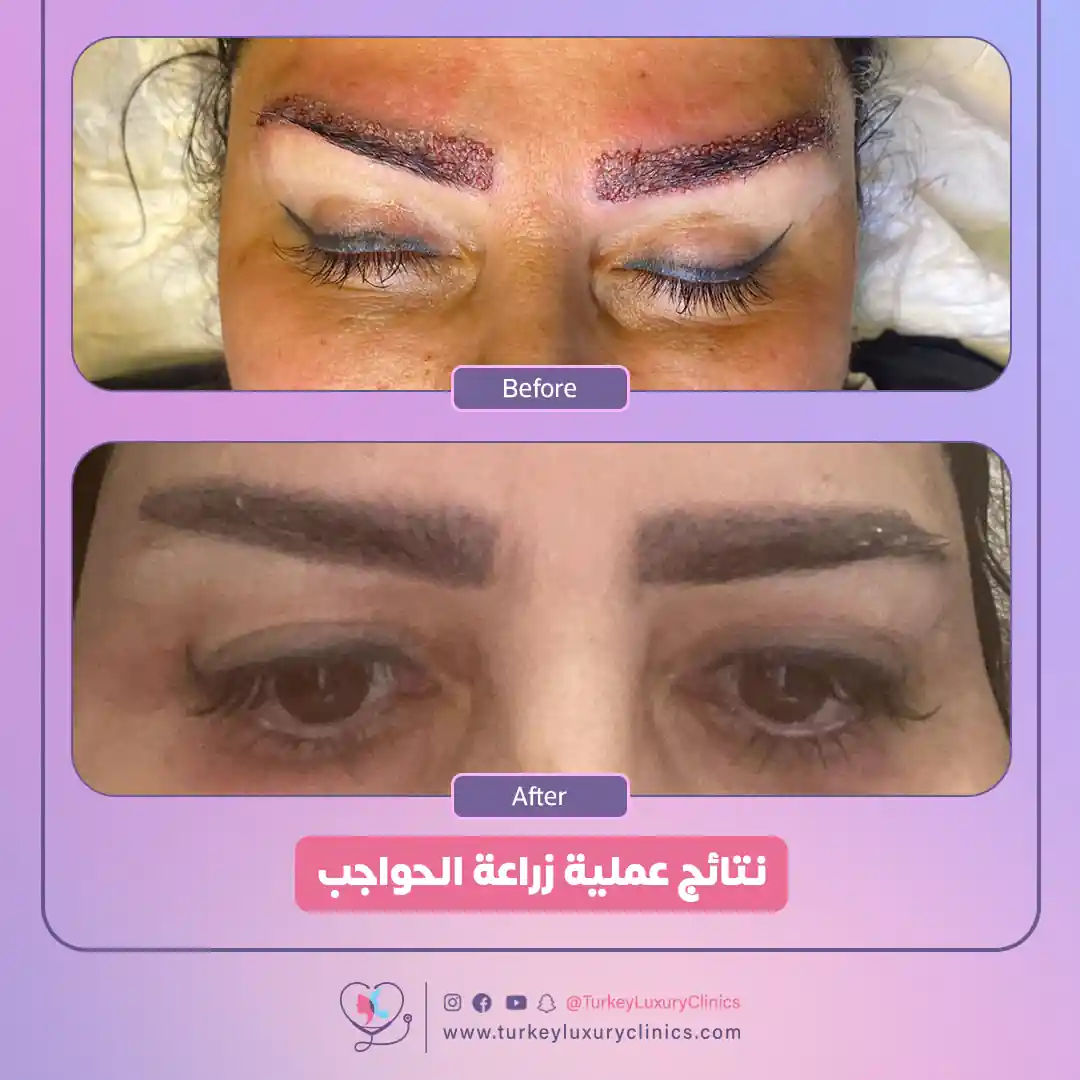 مقارنة تكلفة زراعة الحواجب في تركيا مع مختلف الدول الأخرى في الجدول التالي: