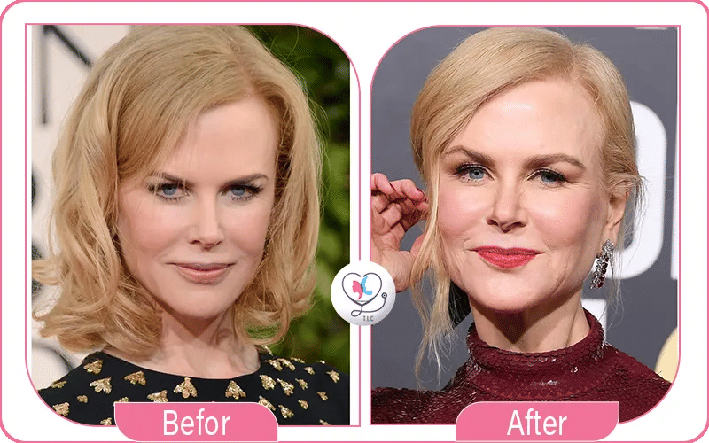 Nicole Kidman Plastic Surgery Before and After