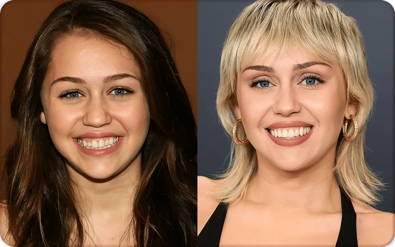 Miley Cyrus Teeth Before and After Veneers