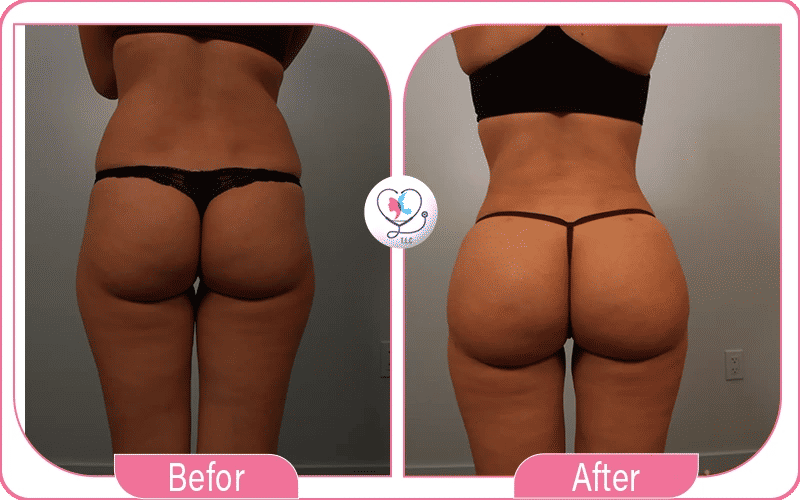 Lipofilling fessier avant / après-2