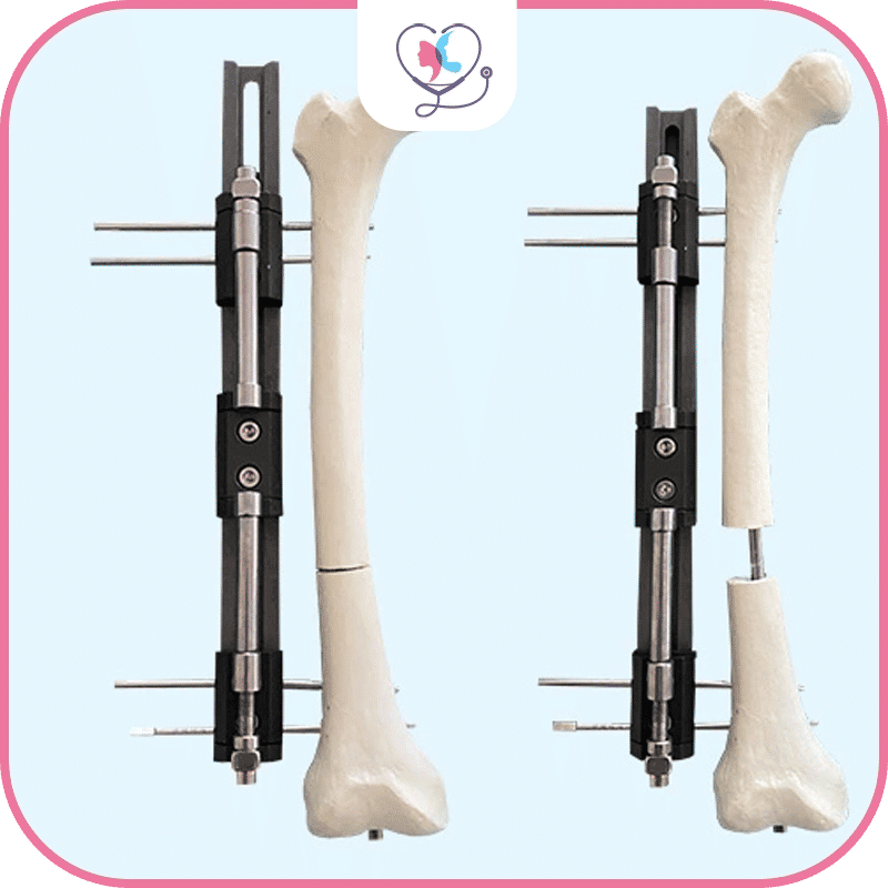 ما هي طريقة لون "LON" لتطويل العظام؟