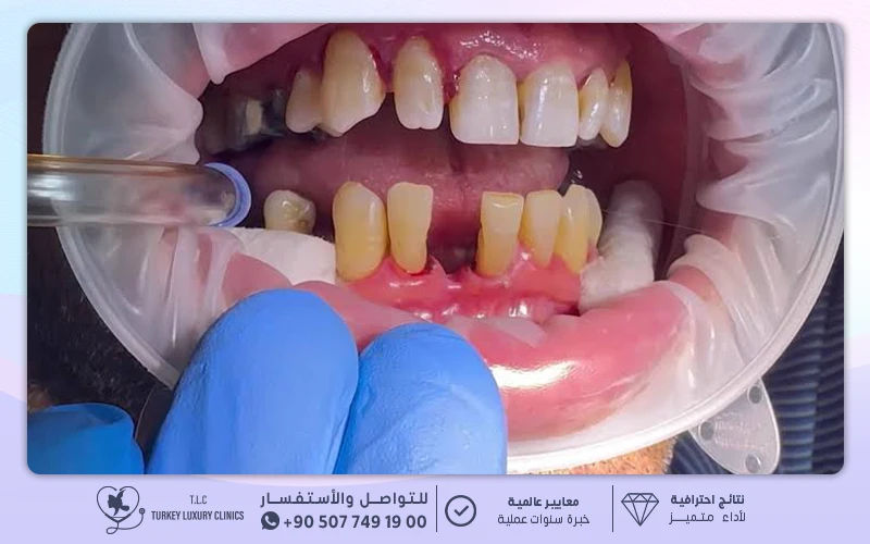 الالتئام والتركيب النهائي للأسنان الالتئام والتركيب النهائي للأسنان
