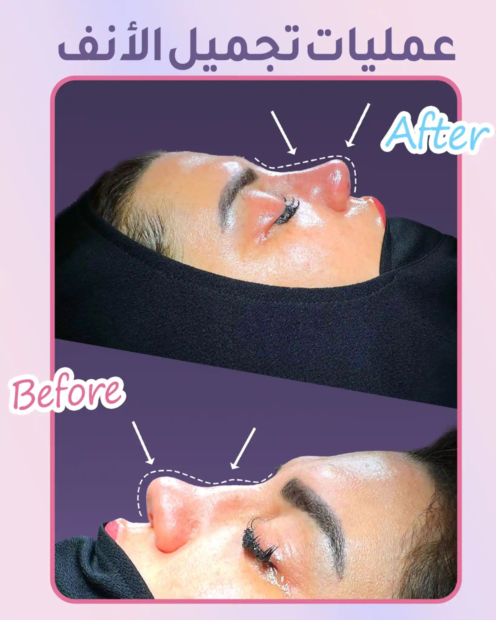 مدة الشفاء بعد عملية تجميل الأنف