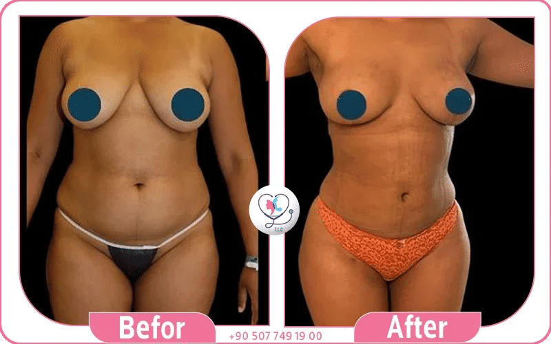 Mommy Makeovers show Flatter stomach, firmer breasts, sculpted curves, rejuvenated look.