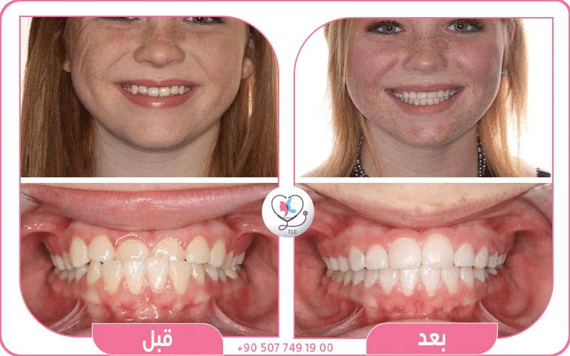 عضة معكوسة