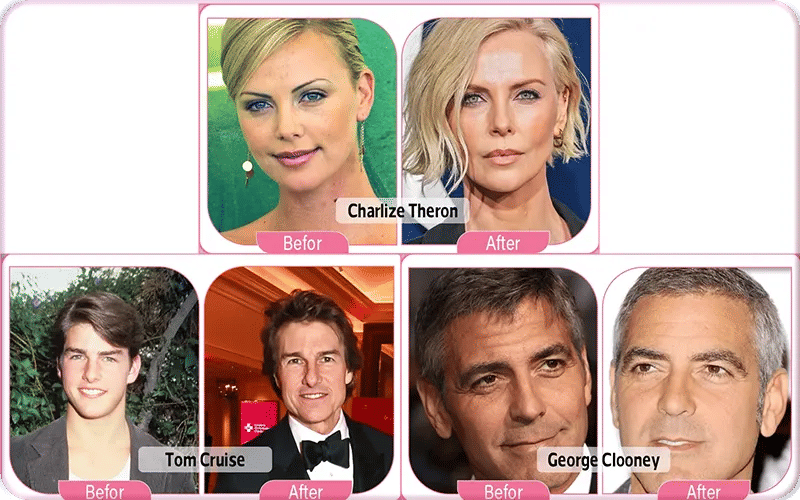 Male Celebrity Blepharoplasty Before and After