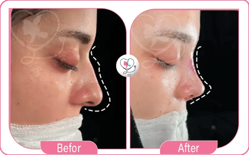 أرنبة الأنف قبل وبعد