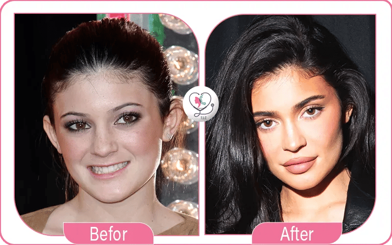 Kylie Jenner avant / après chirurgie